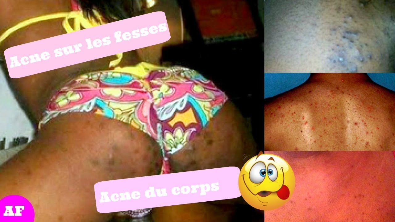 DITES ADIEU AUX BOUTONS DU CORPS ( SUR LES FESSES, POITRINES ET DOS)